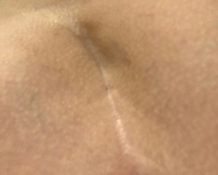 Tailbone scar/no consent surgical evidence